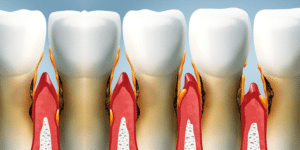 about periodontal disease
