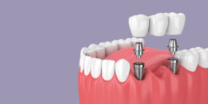replacing multiple teeth dental implants