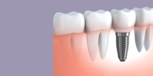 replacing single tooth dental implant
