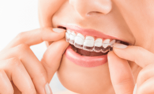 invisalign american dental wellness orange park fl