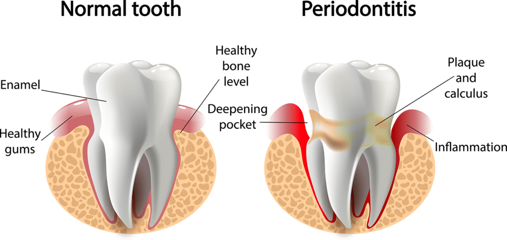 american dental wellness Periodontal disease diagram