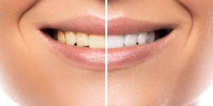 dental teeth whitening orange park fl